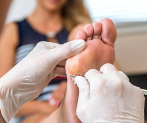 Chiropodist removes skin on a wart with a scalpel on the sole of foot
