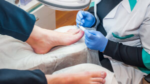 Podiatrist treating toenail fungus. Doctor removes calluses, corns and treats ingrown nail.