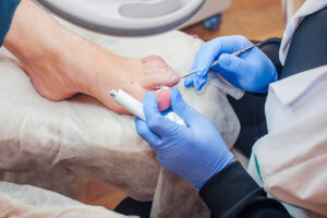 Podiatrist treating toenails. Doctor removes calluses, corns and treats ingrown nail.